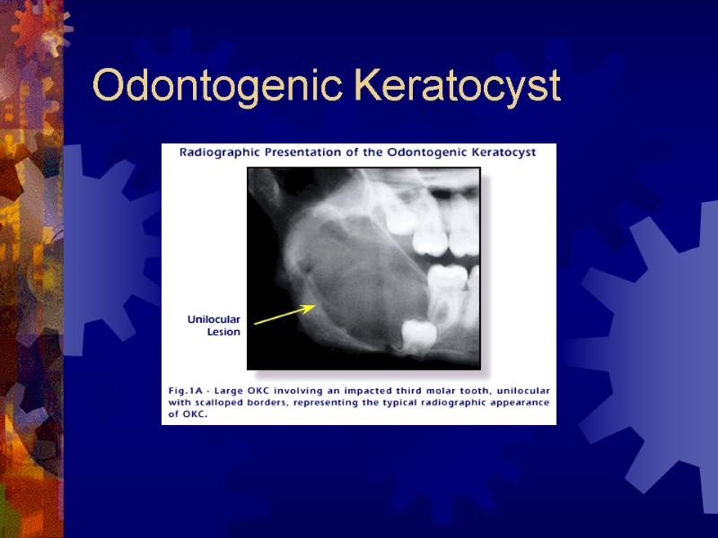 Odontogenic Keratocyst